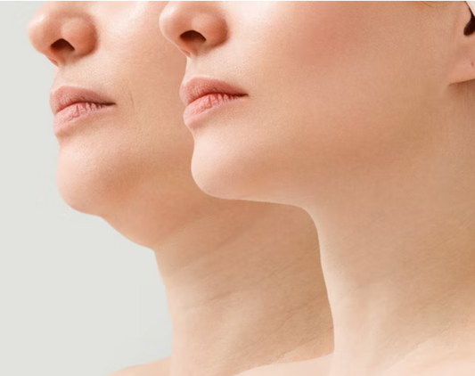 Everesse Non-Invasive Skin Tightening and Lifting (2 Treatment Package)