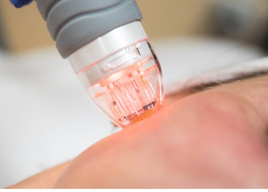 Scarlet RF Microneedling with Exosome Treatment